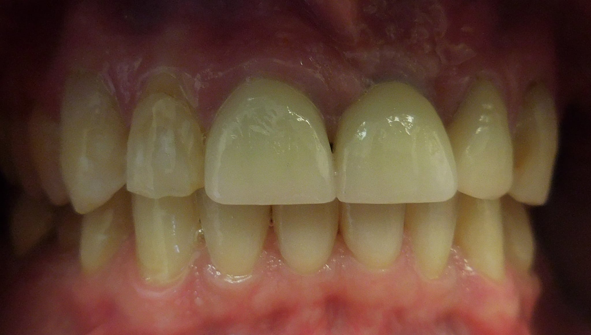 Implant After Smile