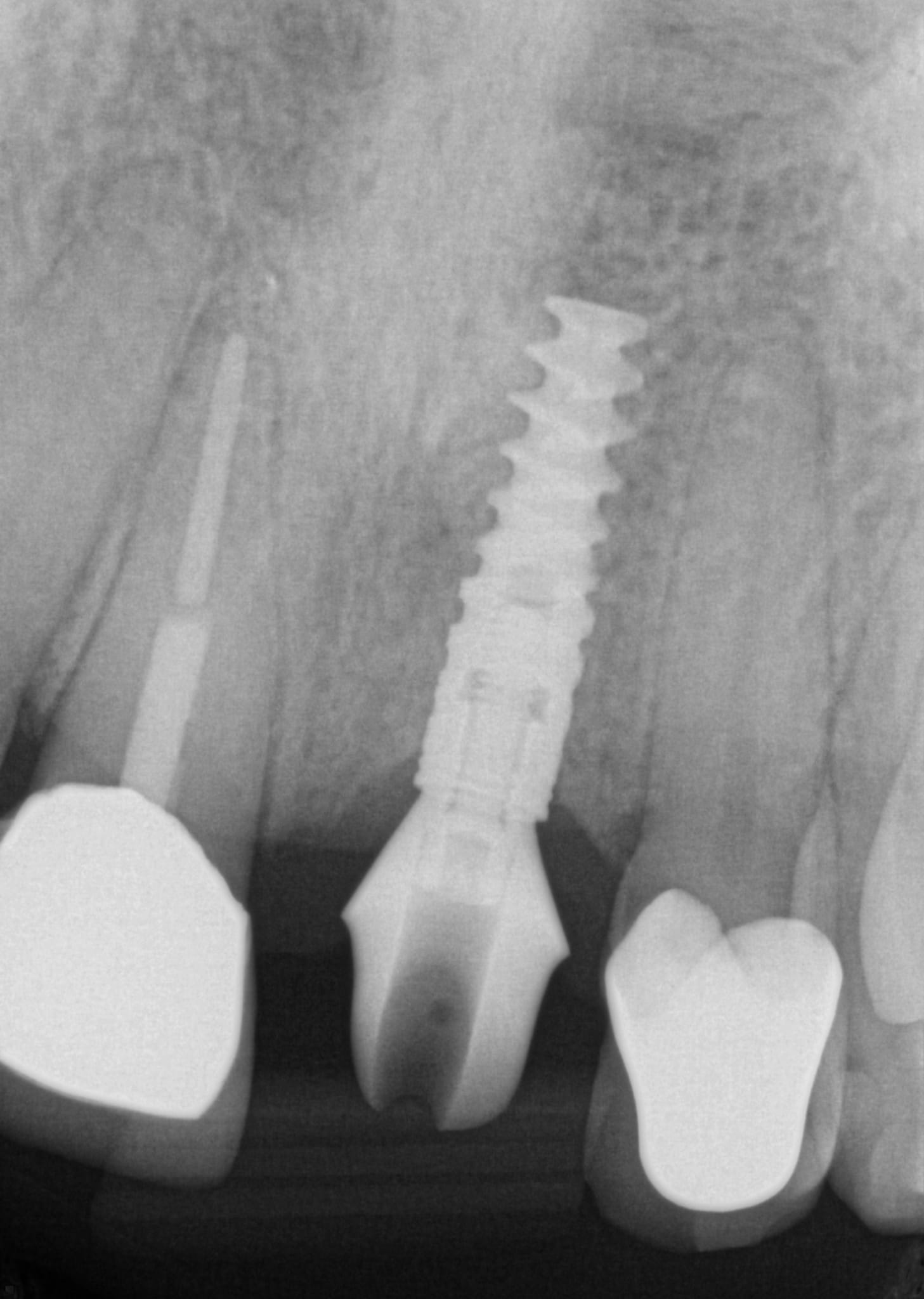 Implant X-Ray of Tooth
