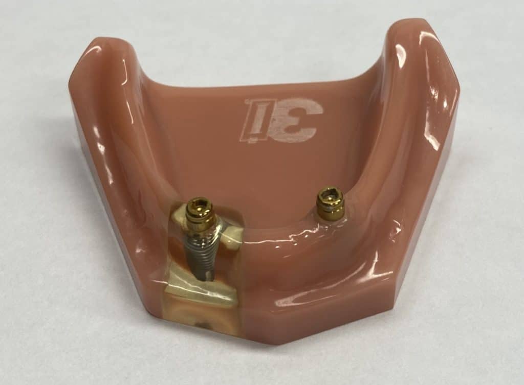 Implant Retained Denture