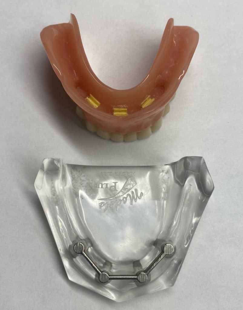 Implant Supported Denture Picture