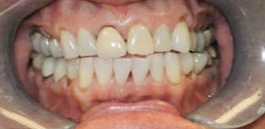 Teeth Before Photo