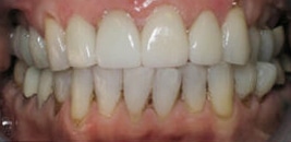 Teeth After Photo