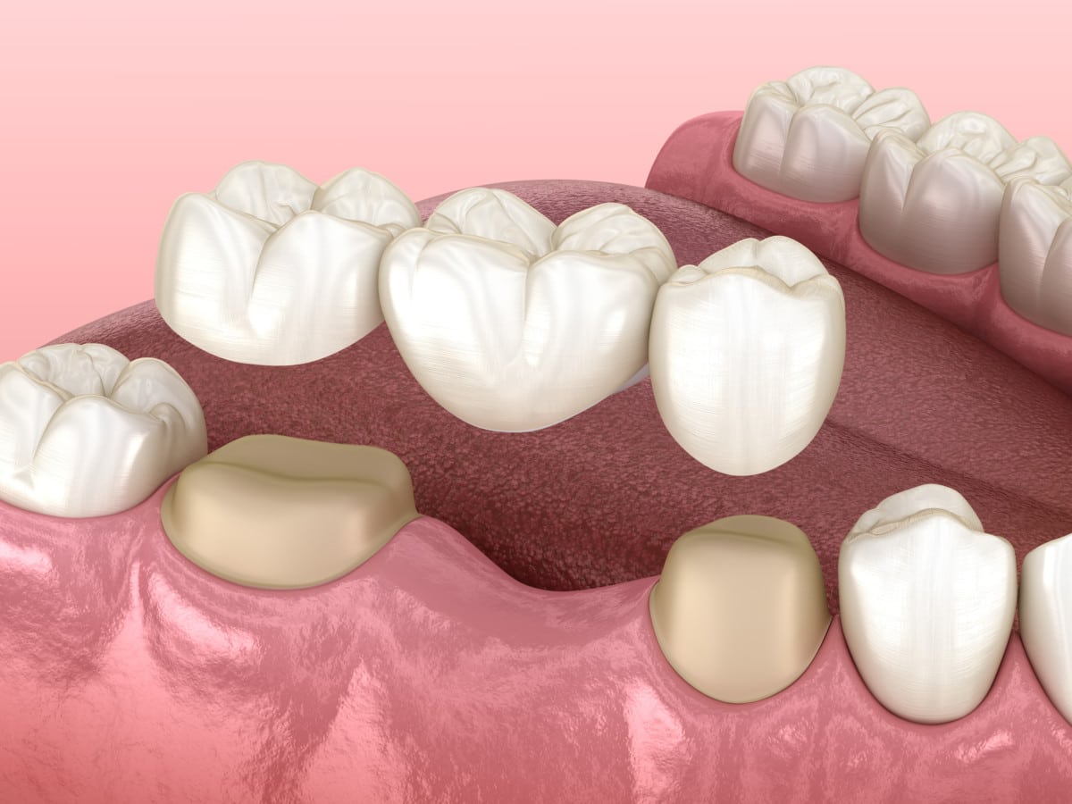 3-tooth porcelain dental bridge