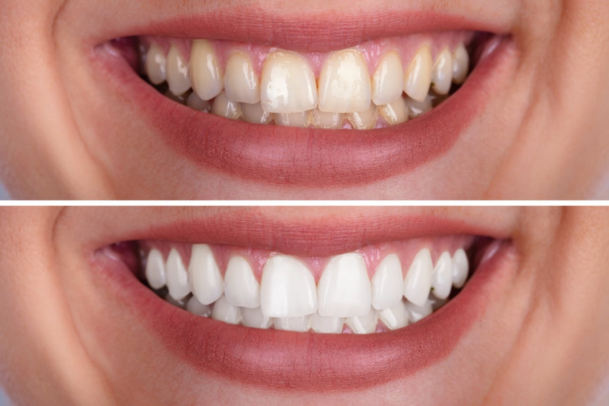 teeth whitening comparison