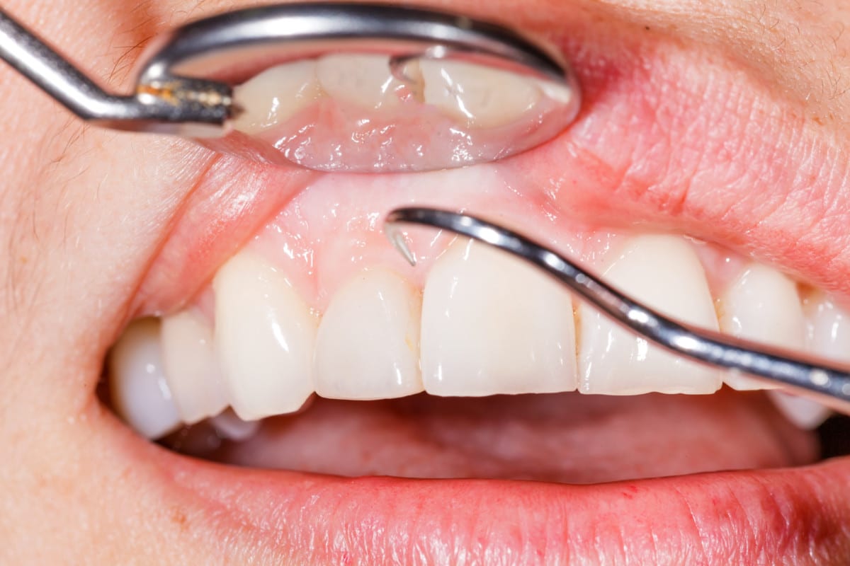 Closeup of periodic dental examination