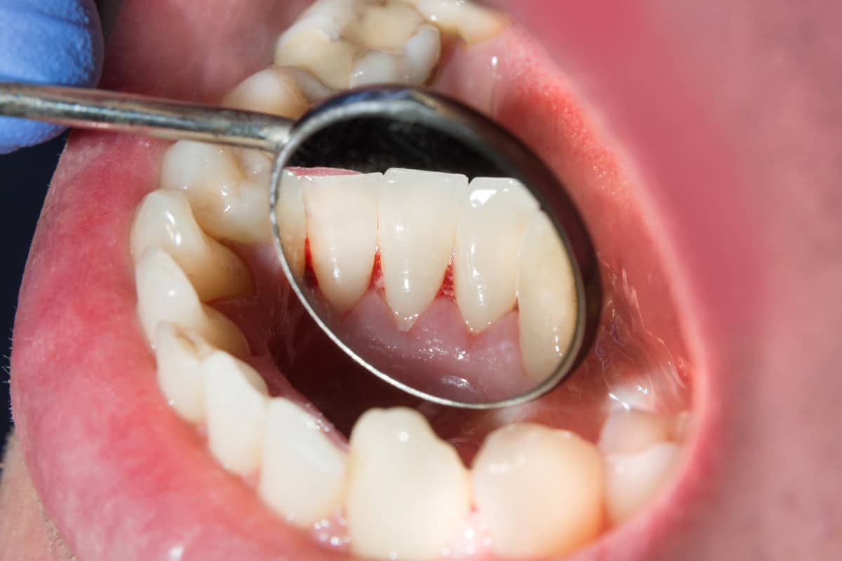 dental patient teeth and gums