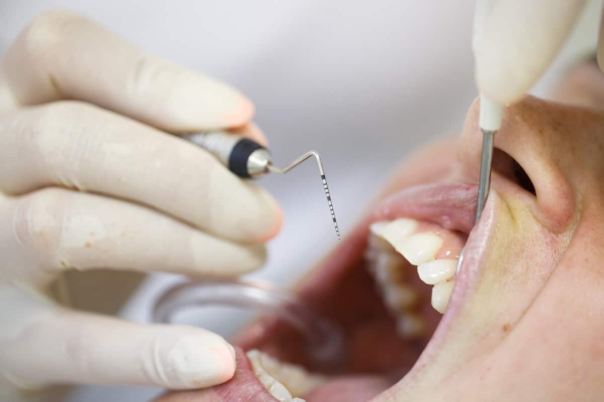 Periodontal probe in patient's mouth