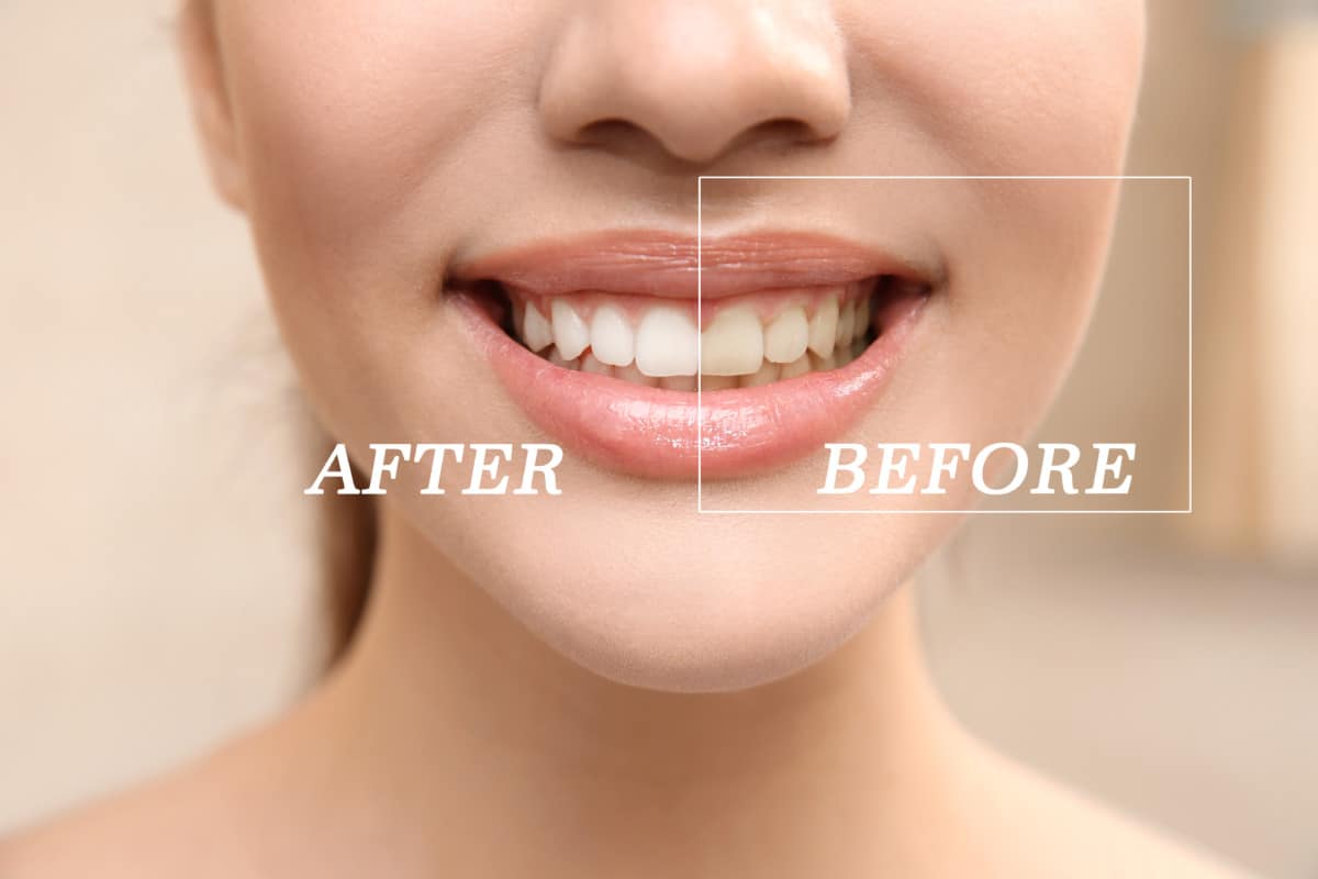 before and after picture showing result of teeth whitening